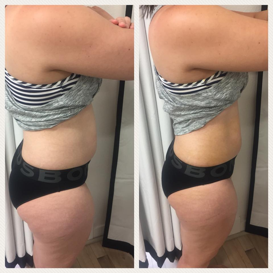A client's before and after photo showcasing the fat loss and body contouring results from an Oceanbeach Oxygen Slimwrap session.