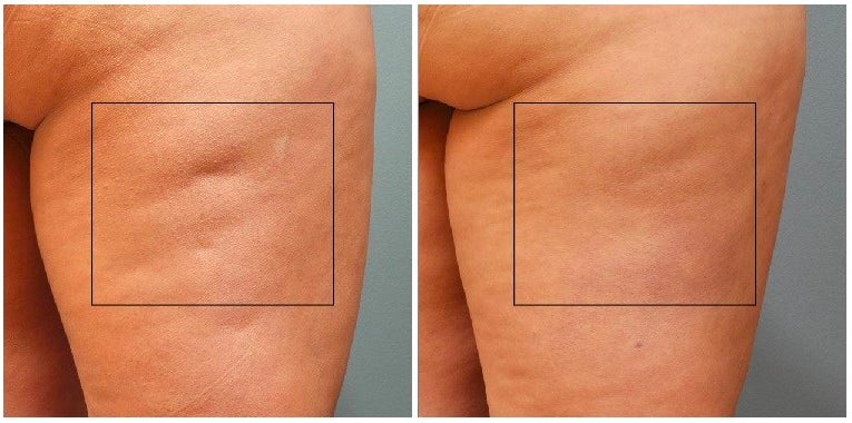 Close-up before and after photo showing a significant reduction in the appearance of cellulite on a thigh after a Slimwrap treatment at Oceanbeach Oxygen.
